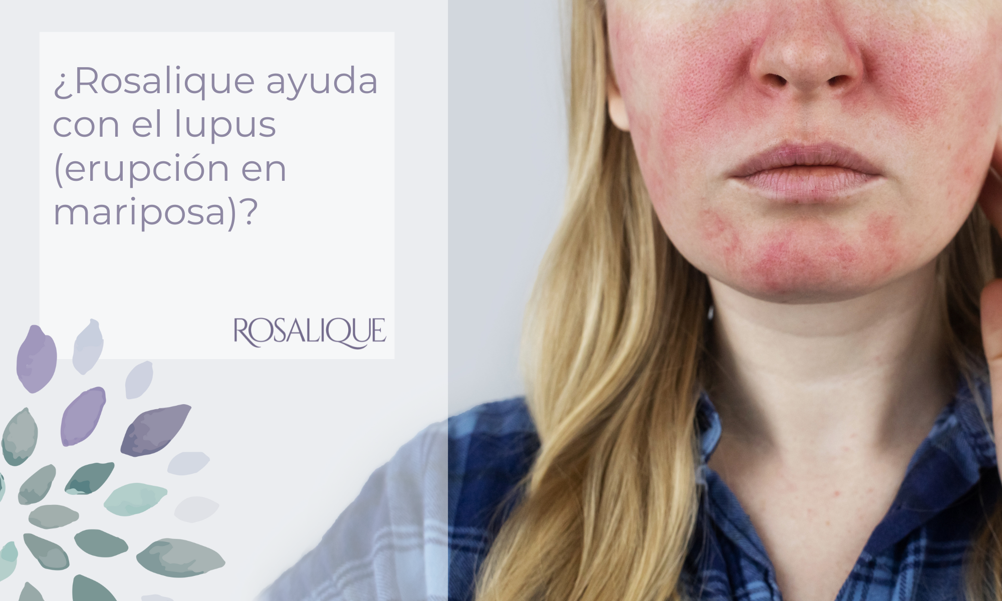 ¿Rosalique ayuda con el lupus (erupción en mariposa)?