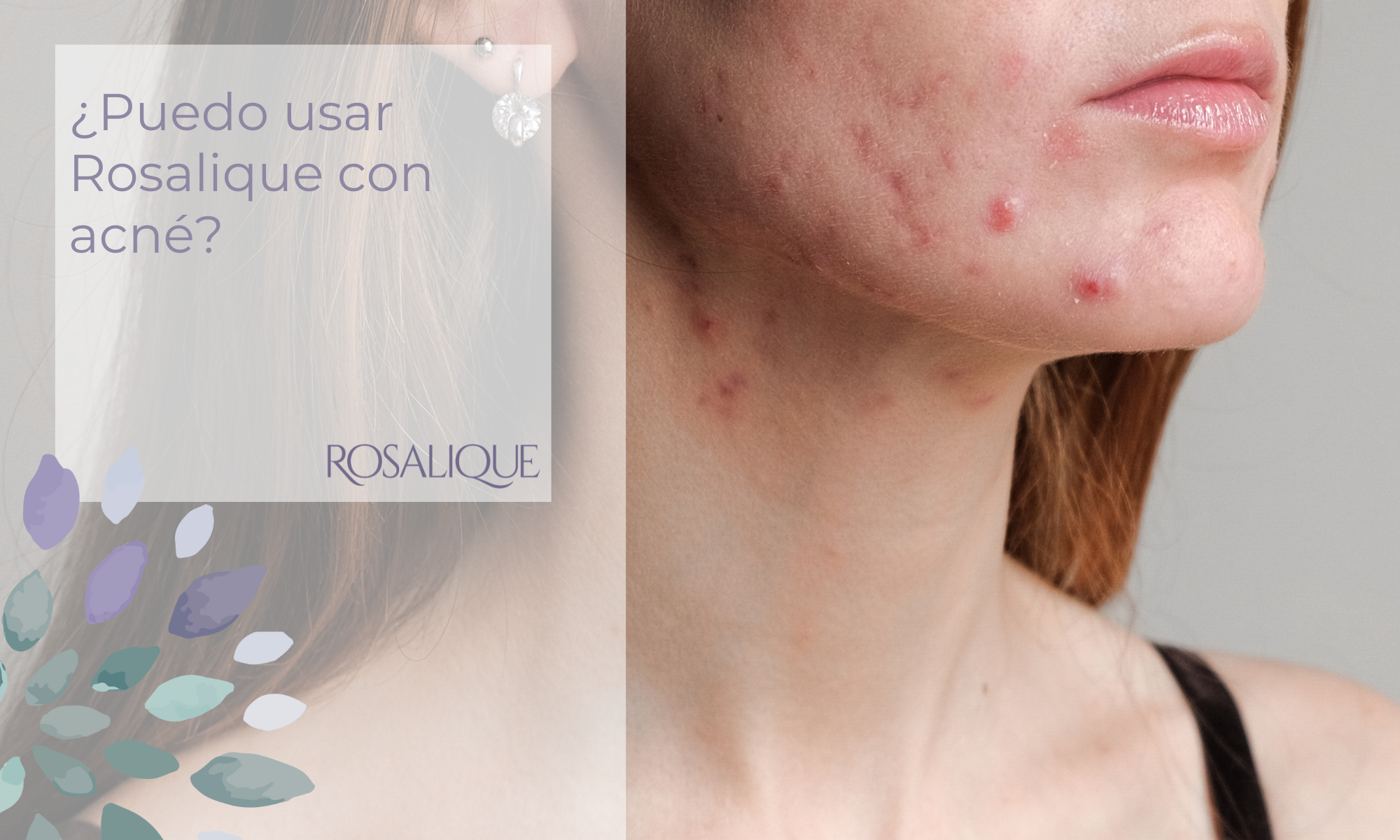 ¿Puedo usar Rosalique con acné?