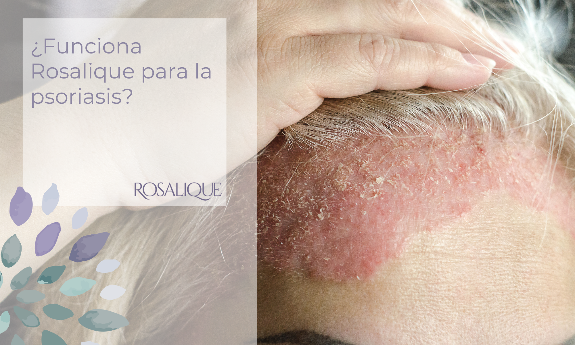 ¿Funciona Rosalique para la psoriasis?