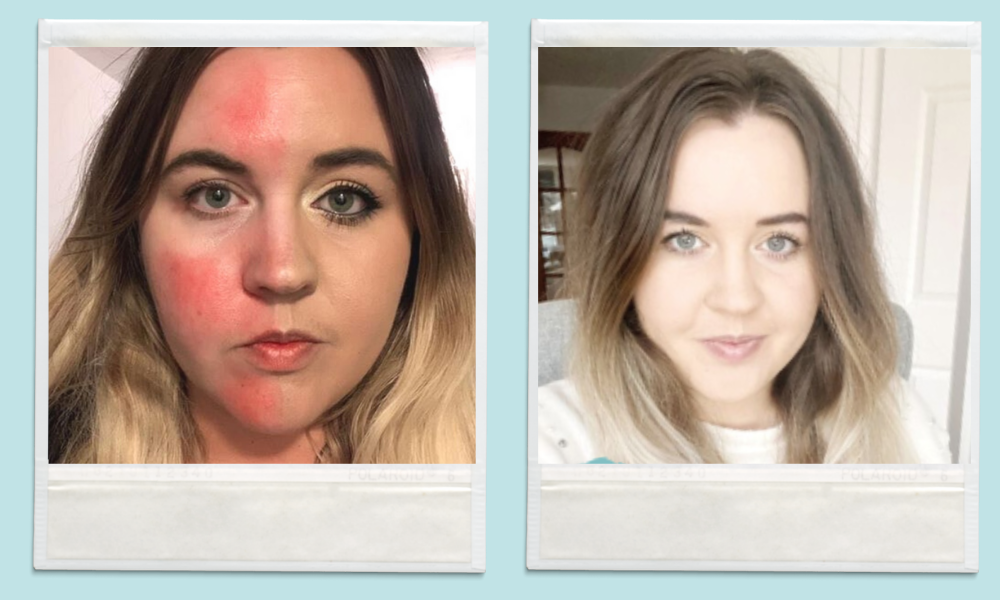 Cuidados de piel para personas con lupus- Emma Lynn