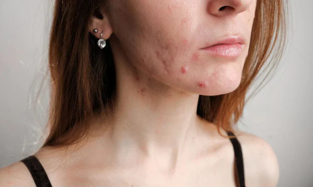 5 tips de maquillaje de verano para acné