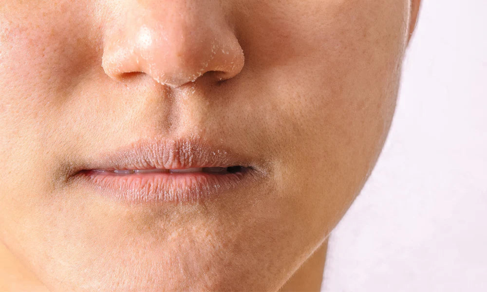 Por qué Rosalique es ideal para eczema: 5 ingredientes clave