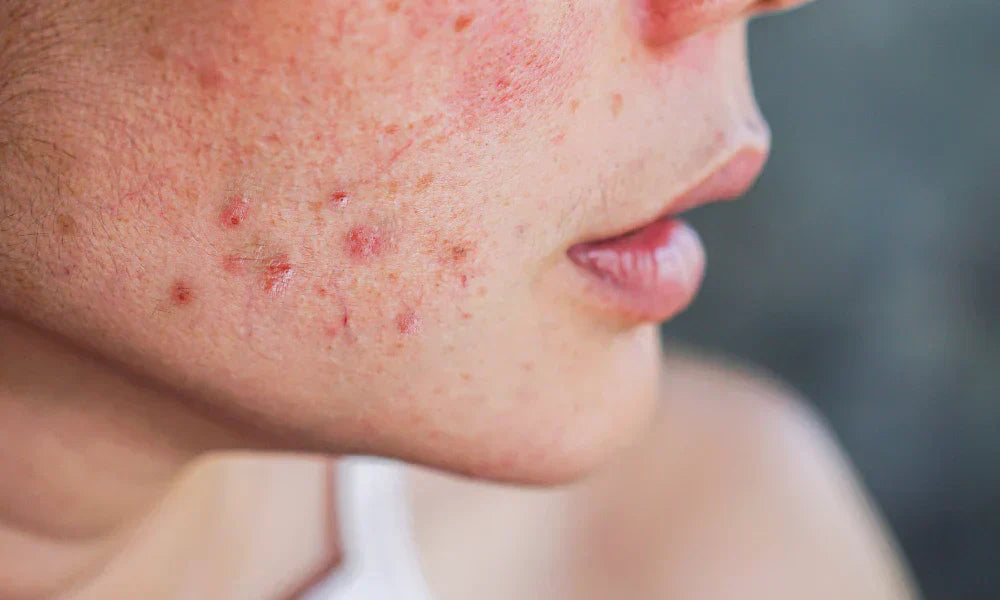 Los pros y contras del acne combinado con la rosácea